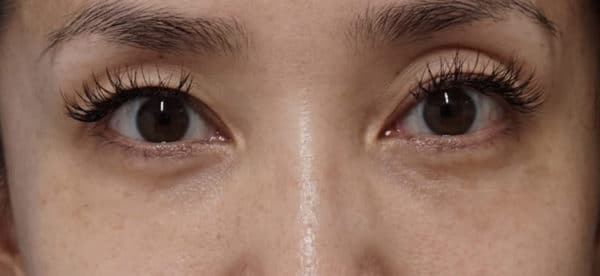 目の下の小じわを改善｜ベビーコラーゲン療法（ヒューマンコラーゲン）症例のBefore写真