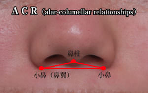 鼻尖形成、鼻中隔延長、小鼻縮小（flap法）