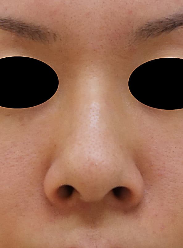 鼻先を伸ばす鼻中隔延長手術（＋プロテーゼ、小鼻縮小）　3ヶ月後のBefore写真