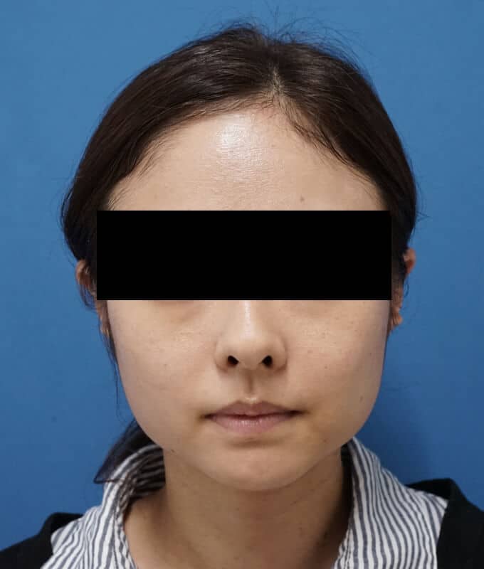 鼻尖縮小＋軟骨移植＋ストラット、鼻翼縮小（内＋外）　３ヶ月後　正面のBefore写真