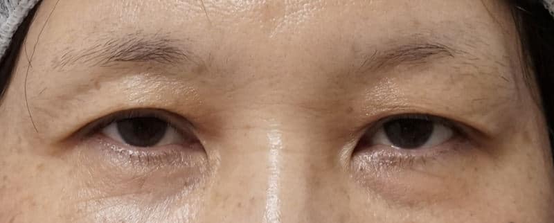 鼻尖縮小＋軟骨移植＋ストラット、鼻翼縮小（内＋外）　３ヶ月後　正面のBefore写真