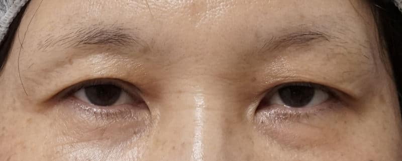 自然な目の上の若返り　眉下切開　3ヶ月後のBefore写真