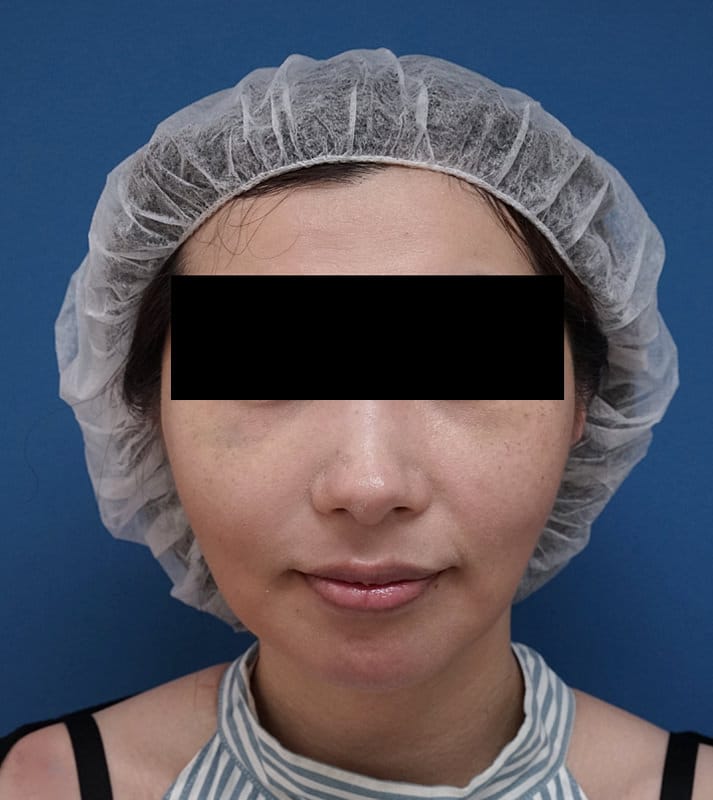 切らずに強力なリフト効果|強力スレッドリフト 1週間後のAfterの写真