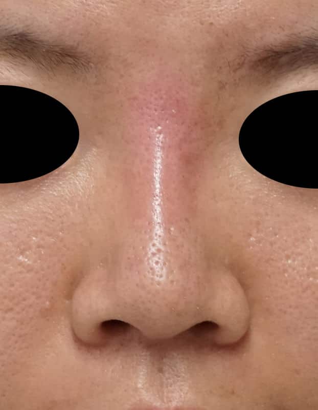 高濃度ヒアルロン酸’(クレヴィエル)で鼻を高く 処置直後のAfterの写真