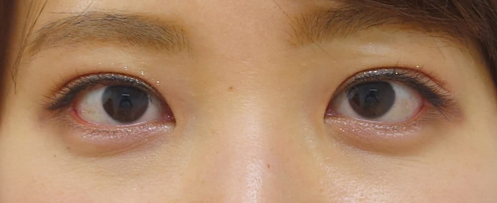 埋没法＋切らないたれ目 1か月後のAfter写真