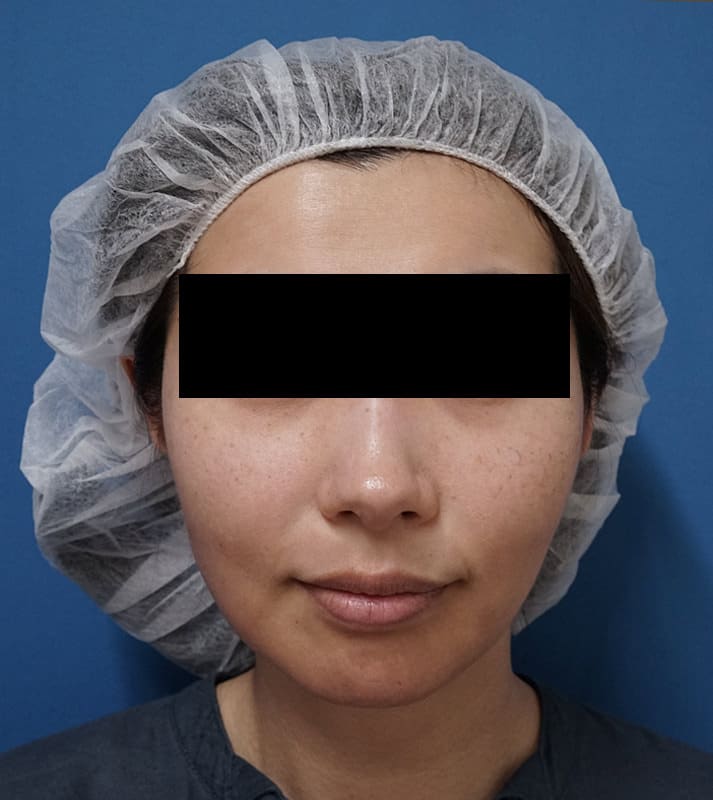 切らずに強力なリフト効果|強力スレッドリフト 1週間後のBefore写真