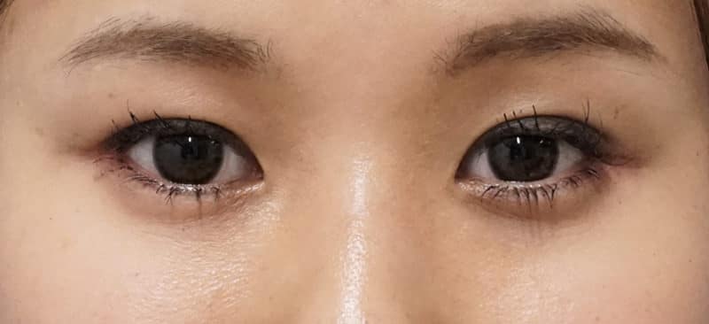 涙袋形成(ヒアルロン酸) 処置直後のAfterの写真