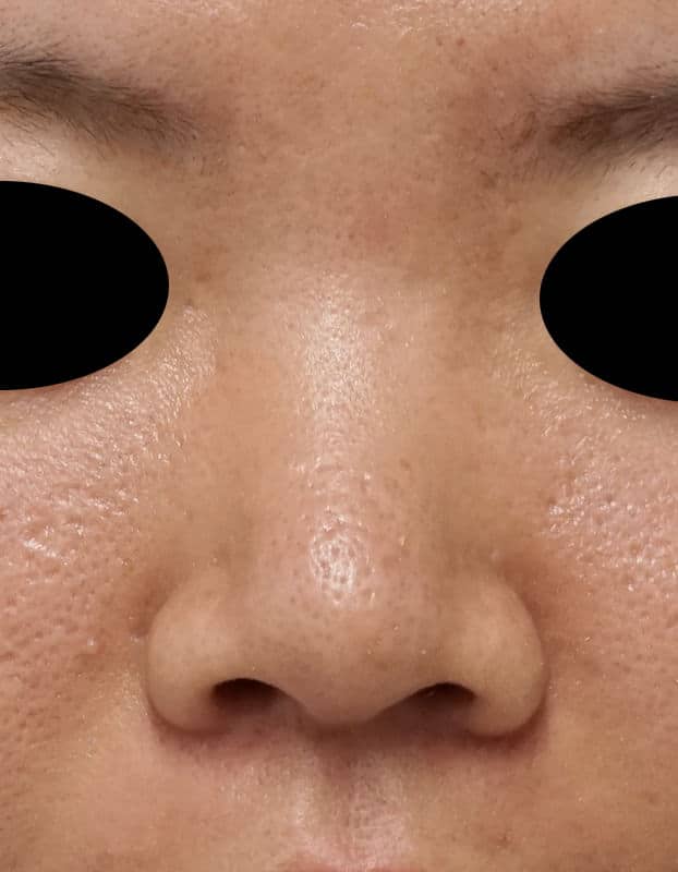 高濃度ヒアルロン酸’（クレヴィエル）で鼻を高く　処置直後のBefore写真
