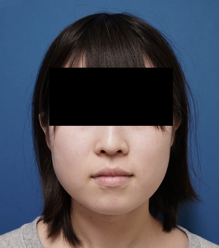 鼻尖縮小＋軟骨移植＋ストラット、鼻翼縮小（内＋外）　３ヶ月後　正面のBefore写真