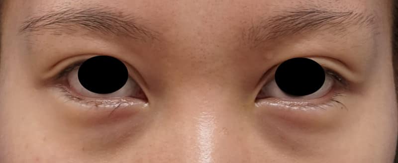 切らないたれ目 1週間後のAfterの写真