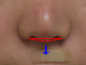 鼻尖形成、鼻中隔延長、小鼻縮小（flap法）　後