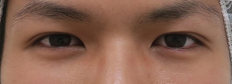 腫れにくい二重術(3点止め) 1か月、3か月の経過のBefore写真