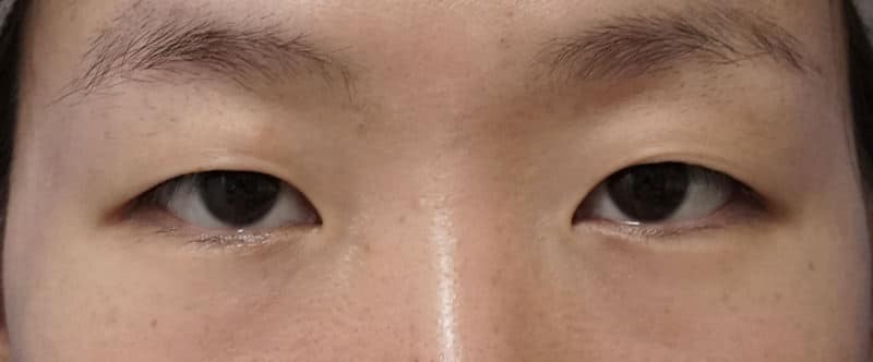 スマートバランス 1ヶ月後のBefore写真