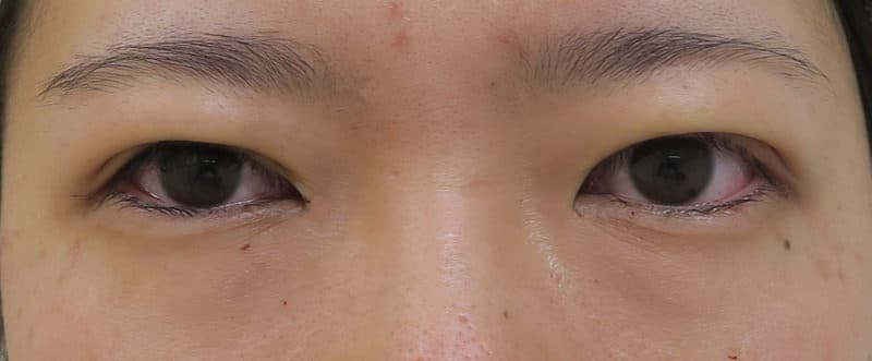 もとびアイプラチナム　手術直後のAfterの写真
