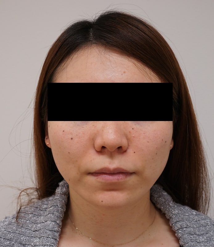 驚きの小顔治療!|エラボトックス 1か月後のBefore写真