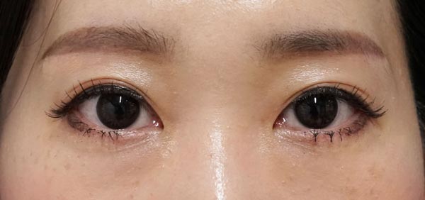眉下切開　３ヶ月後のAfter写真