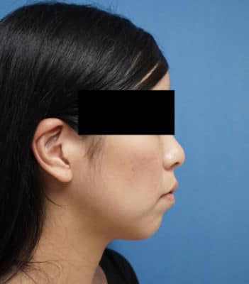 高濃度ヒアルロン酸（クレヴィエル）　アゴ　１週間後のBefore写真
