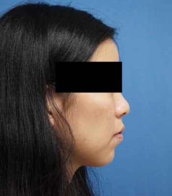 高濃度ヒアルロン酸（クレヴィエル）　アゴ　１週間後のAfterの写真