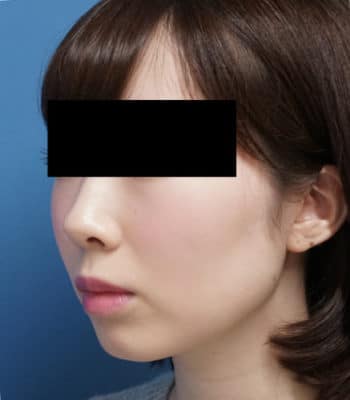 クレヴィエル（アゴ）　1週間後のBefore写真