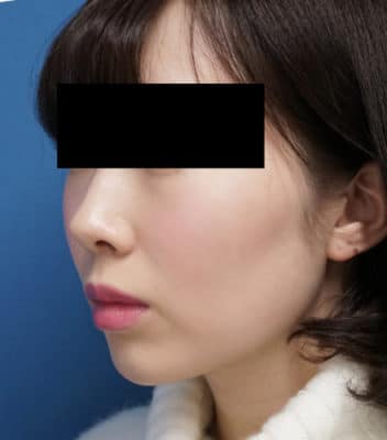 クレヴィエル（アゴ）　1週間後のAfterの写真
