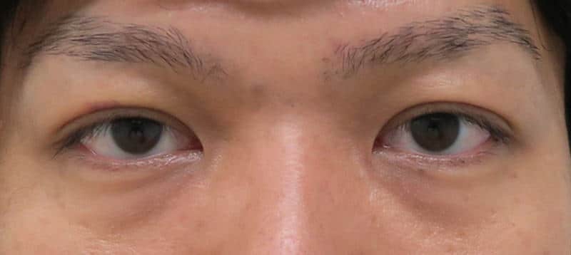 もとびアイプラチナム　1週間後のAfterの写真