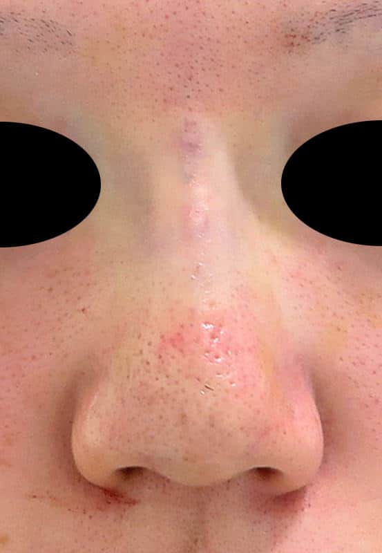 実はそんなに腫れない!? 鼻のプロテーゼ(隆鼻術)の手術直後のAfterの写真