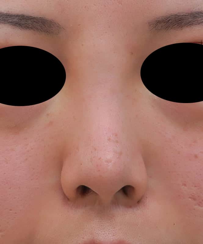 切らない鼻翼縮小 手術直後のAfterの写真