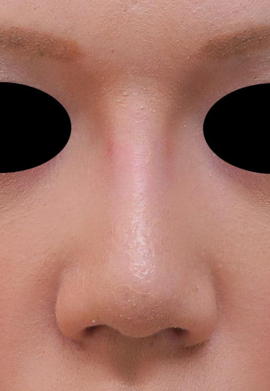 高めのお鼻プロテーゼ　１週間後のAfter写真