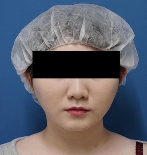 美容外科スタッフさん脂肪吸引（ホホ・ホホ骨・アゴ下）　３か月後のAfterの写真