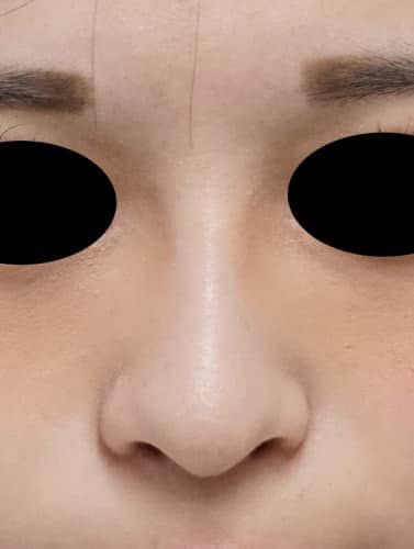 鼻プロテーゼ 1週間後のAfterの写真