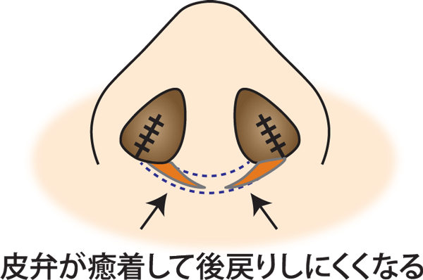 鼻翼縮小（フラップ法）癒着