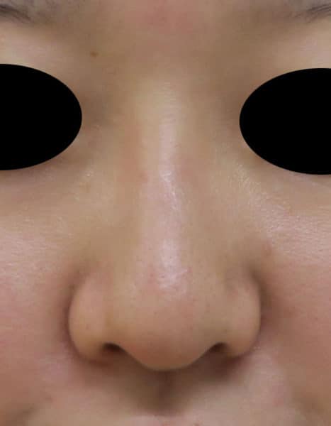 鼻尖形成3D法 1週間後のBefore写真