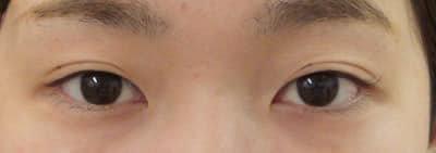 鼻尖縮小＋軟骨移植＋ストラット、鼻翼縮小（内＋外）　３ヶ月後　正面のBefore写真