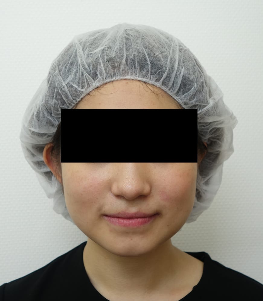 強力小顔ボトックス　1か月後のBefore写真