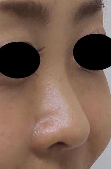 お鼻のヒアルロン酸注入後のBefore写真