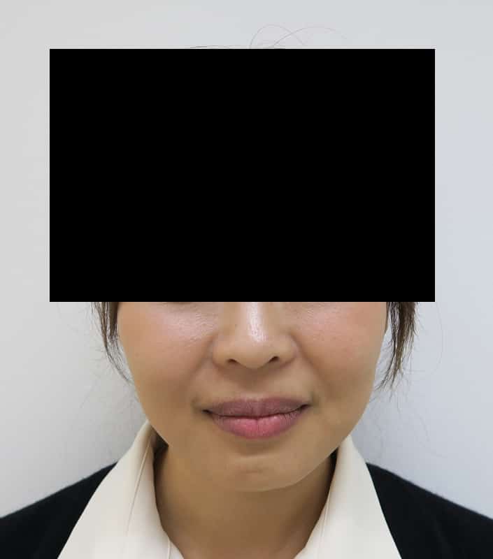 鼻尖縮小＋軟骨移植＋ストラット、鼻翼縮小（内＋外）　３ヶ月後　正面のBefore写真