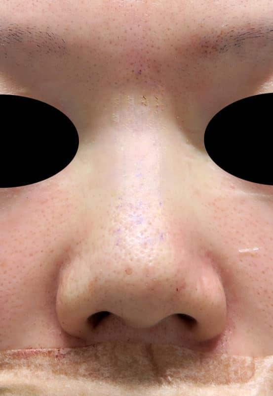 鼻尖縮小＋軟骨移植＋ストラット、鼻翼縮小（内＋外）　３ヶ月後　正面のBefore写真