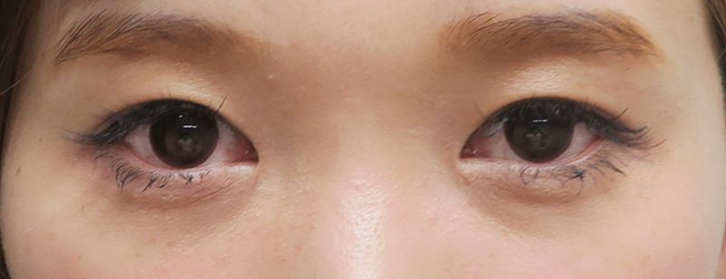 鼻尖縮小＋軟骨移植＋ストラット、鼻翼縮小（内＋外）　３ヶ月後　正面のBefore写真