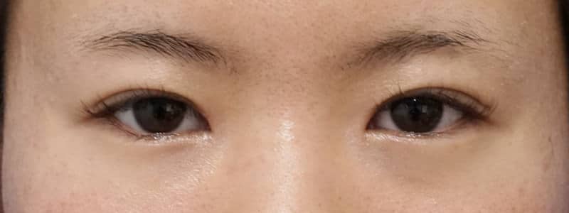 他院切らない眼瞼下垂後再手術　1ヶ月後のBefore写真