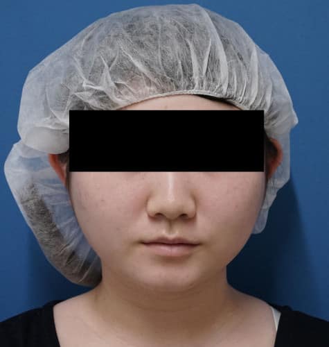 美容外科スタッフさん脂肪吸引（ホホ・ホホ骨・アゴ下）　３か月後のBefore写真