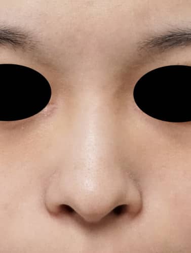 鼻プロテーゼ 1週間後のBefore写真
