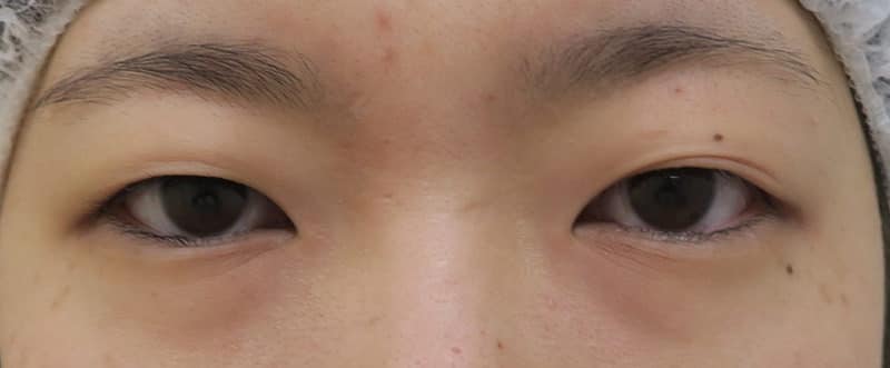 もとびアイプラチナム　手術直後のBefore写真
