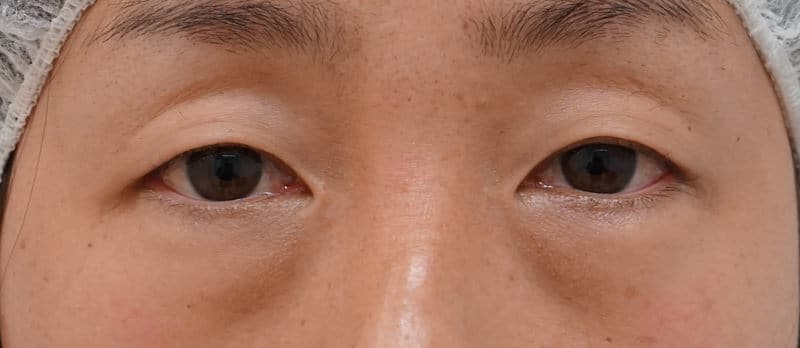 切らない眼瞼下垂プレミアム　1ヶ月後のBefore写真