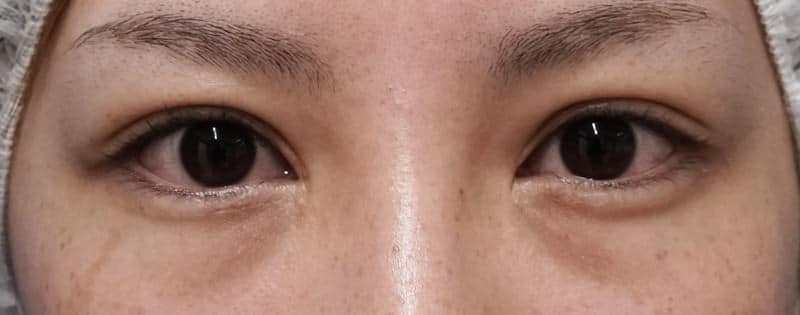 抜糸８点、脂肪・眼輪筋除去、広めの埋没法　手術直後の腫れは？？のBefore写真