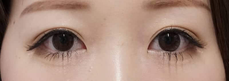 美容スタッフさんのもとびアイプラチナム 1週間後のAfterの写真