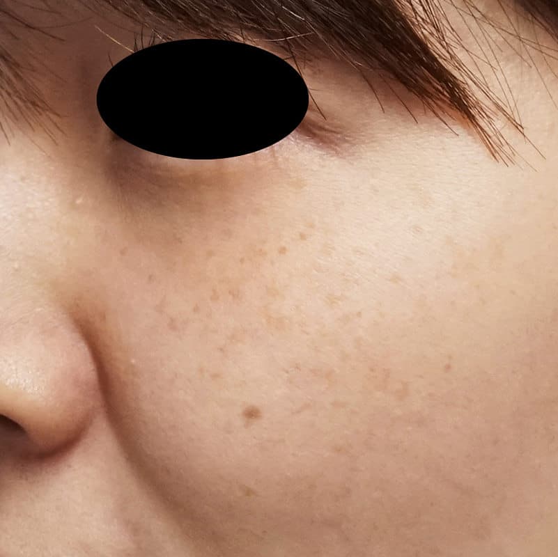 鼻尖縮小＋軟骨移植＋ストラット、鼻翼縮小（内＋外）　３ヶ月後　正面のBefore写真