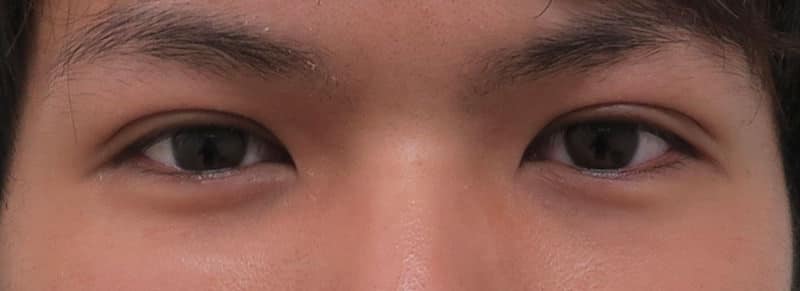 腫れにくい二重術(3点止め) 1か月、3か月の経過のAfterの写真