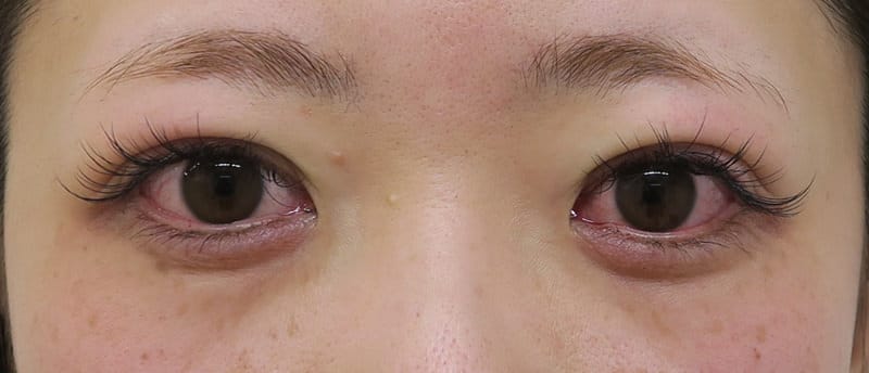 腫れにくい!もとびアイプラチナム 手術直後のAfterの写真