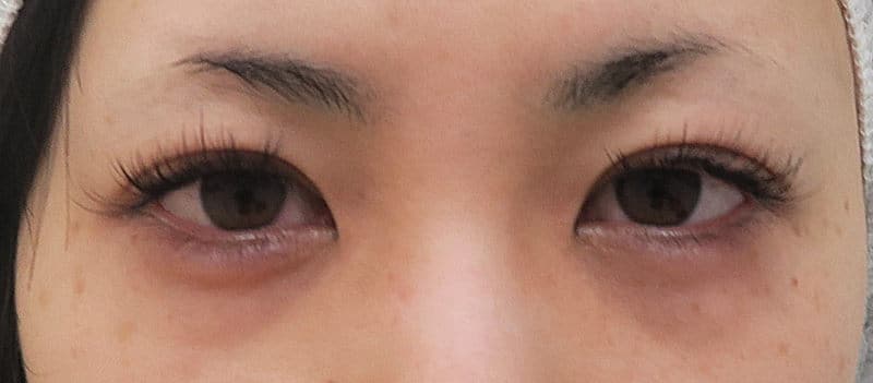 鼻尖縮小＋軟骨移植＋ストラット、鼻翼縮小（内＋外）　３ヶ月後　正面のBefore写真