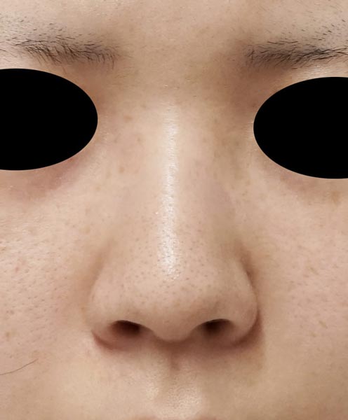 鼻尖縮小＋軟骨移植＋ストラット、鼻翼縮小（内＋外）　３ヶ月後　正面のBefore写真